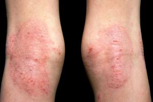 Picture of atopic eczema on back of the knees