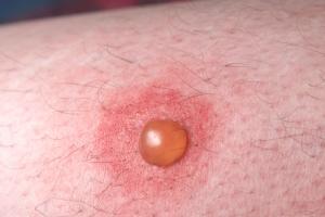 Blister on a man’s leg showing inflammation