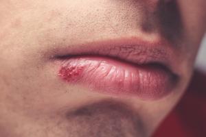 Picture of a cold sore on a lip