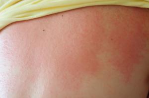 Prickly heat (heat rash) on a back