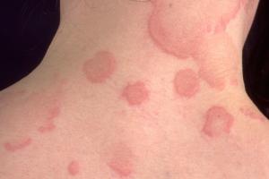 Urticaria rash (hives) on a neck and back