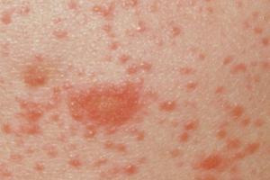 Lichen planus skin rash on back
