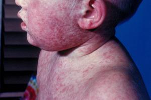 Picture of a child with measles
