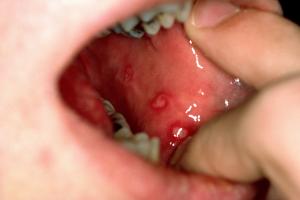 Picture showing multiple mouth ulcers on the inner surface of a cheek