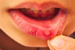 Picture of a single ulcer on a lip