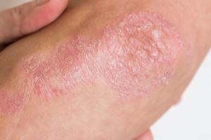 Picture showing psoriasis that causes red, flaky, crusty patches of skin covered with silvery scales
