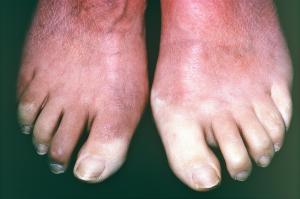 Picture of pale toes caused by Raynaud’s