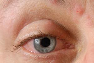 Conjunctivitis caused by a viral infection