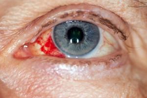 Eye with burst blood vessel