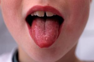 Picture showing a red and swollen tongue