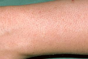 Picture showing arm with keratosis pilaris