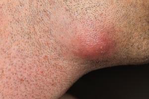 Picture showing skin abscess