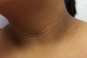 Acanthosis nigricans on a neck