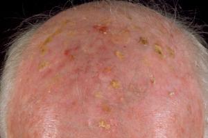 Actinic keratoses on the scalp