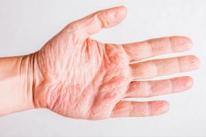 Picture of atopic eczema on the palm of the hand