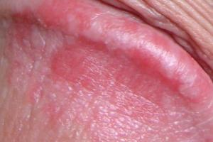 Penile shaft pink bumps on Lump on