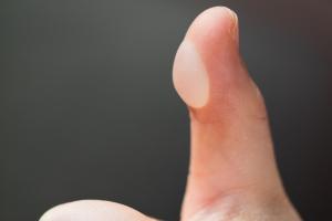 Blister on a left thumb Blister on a left thumb