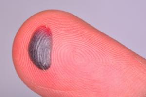 Blood blister on finger tip 