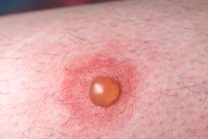 Blister on a man’s leg showing inflammation Blister on a man’s leg showing inflammation