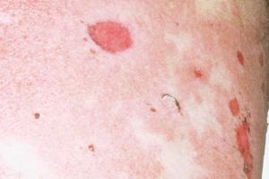 Bullous pemphigoid usually starts as sore, itchy red patches Bullous pemphigoid on the body