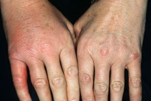 Picture showing cellulitis affecting the little finger on the right hand