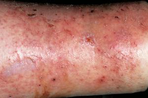 Picture showing cellulitis affecting the lower leg