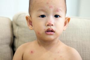 In milder cases of chickenpox there may only be a few spots