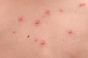 Chickenpox spots normally appear in clusters 