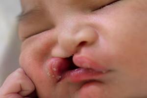 Newborn baby with cleft lip and palate