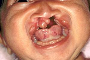 Baby with more extensive cleft lip and palate