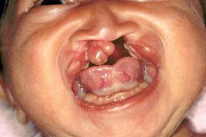 Baby with more extensive cleft lip and palate Baby with more extensive cleft lip and palate