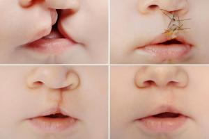Four pictures of a baby with cleft lip and palate - before and after surgery Four pictures of a baby with cleft lip and palate - before and after surgery