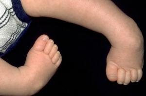 Picture of baby with club foot in both feet