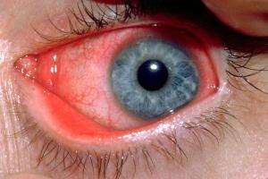 Eye with conjunctivitis