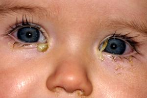 Baby with conjunctivitis Picture of a baby with conjunctivitis