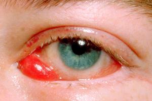 An eye showing swelling as a result of oedema of the conjunctiva