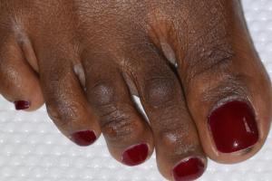 Picture of corns on the back of the second and third toes