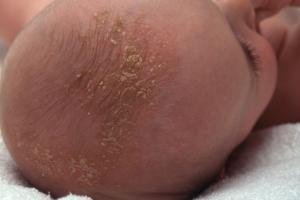 Baby with cradle cap Picture of baby with cradle cap
