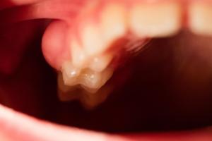 Picture showing dental abscess