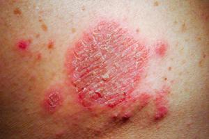 Close up picture of a patch of discoid eczema Close up picture of a patch of discoid eczema