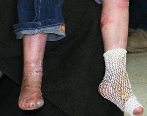 Blistering and lesions on lower legs and foot caused by epidermolysis bullosa Blistering and lesions on lower legs and foot caused by epidermolysis bullosa