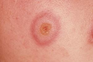 Picture showing erythema multiforme rash – the spots look like targets