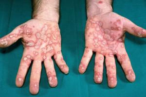 Erythema multiforme shown on the palms of both hands