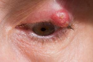 Picture showing a cyst on the upper eyelid 
