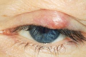 Picture showing a stye on the upper eyelid 