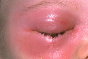 Picture showing orbital cellulitis