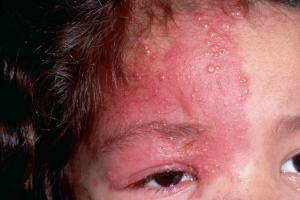 Picture showing shingles on the face and eye Picture showing shingles on the face and eye