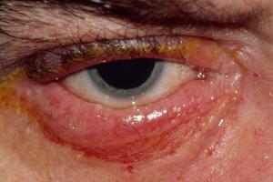 An eye affected by blepharitis 