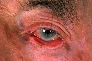 Picture showing an eyelid ectropion 