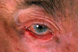 Picture showing eyelid ectropion Picture showing an eyelid ectropion